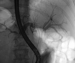 <span class="mw-page-title-main">Klatskin tumor</span> Medical condition