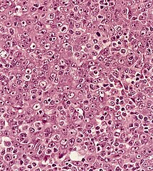 Undifferentiated nasopharyngeal carcinoma—high power