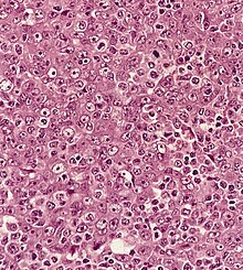 Lymphoepithelioma met to LN 6.jpg