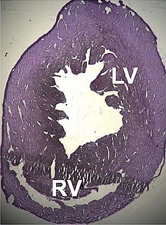 Dilated cardiomyopathy intrinsic cardiomyopathy that is characterized by an an enlarged heart and damage to the myocardium causing the heart to pump blood inefficiently