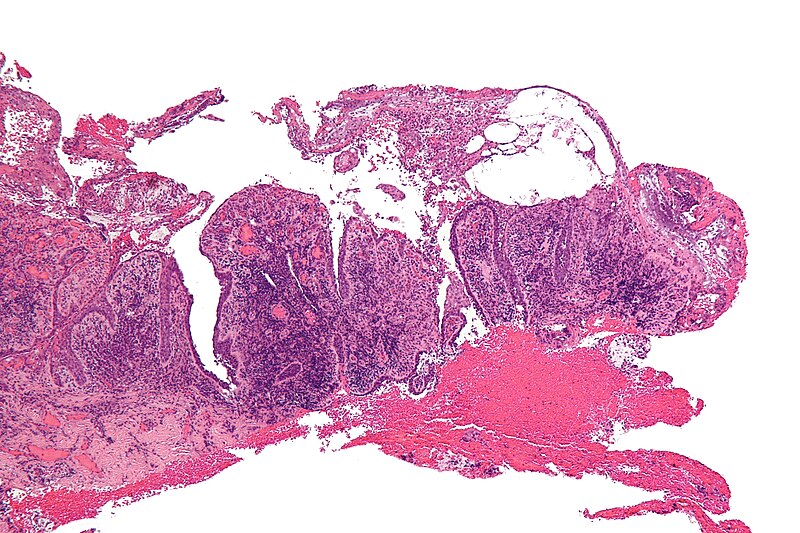 File:Pemphigus vulgaris - low mag.jpg