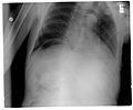 Another pneumoperitoneum on chest X-ray.