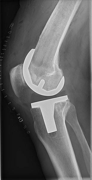 File:Postoperative X-ray of normal knee prosthesis, lateral view.jpg