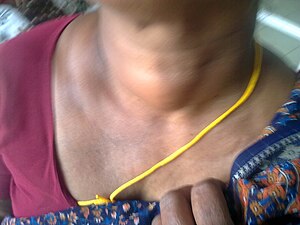 Thyroid adenoma.jpg