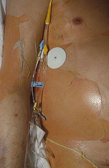 File:Toxic-epidermal-necrolysis.jpg