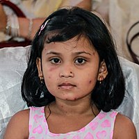 A child with chickenpox on her face.