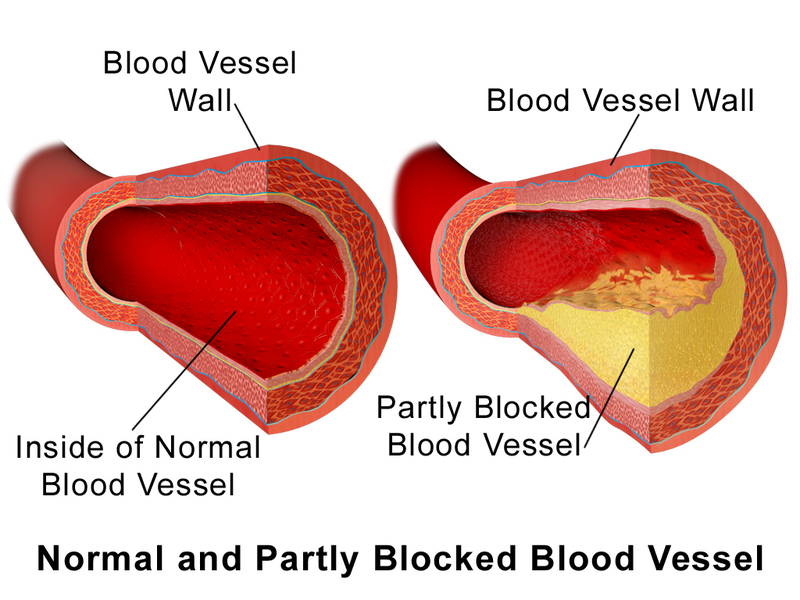 File:Blausen 0052 Artery NormalvPartially-BlockedVessel.png