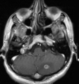 הדמיית תהודה מגנטית (MRI) של גרורה במוח