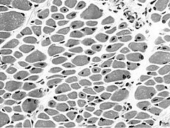 September 20: Muscle biopsy from a girl with X-linked myotubular myopathy