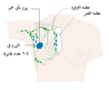 مرحلة 3A في سرطان الثدي