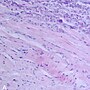 Thumbnail for Endomyocardial biopsy