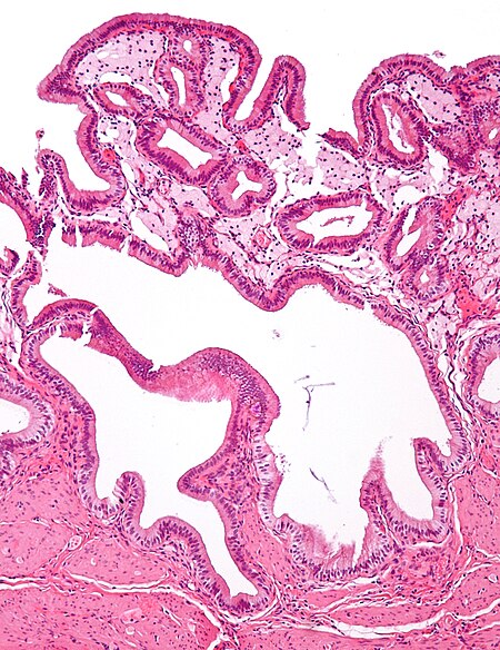 Gallbladder cholesterolosis intermed mag.jpg