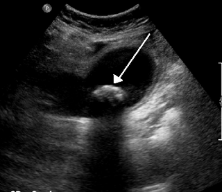 <span class="mw-page-title-main">Biliary colic</span> Medical condition in which gallstones cause acute pain