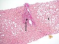 Histopathology of steatohepatitis with mild fibrosis in the form of fibrous expansion (Van Gieson's stain)[86]