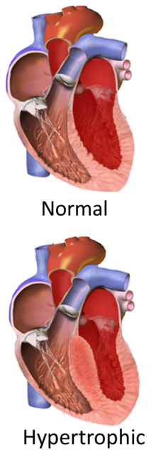 Hypertrophic cardiomyopathy - Wikipedia
