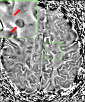 MRI brain scan produced using a Gradient-echo phase sequence showing an iron deposit in a white matter lesion (inside green box in the middle of the image; enhanced and marked by red arrow top-left corner) Journal.pone.0057573.g005 cropped.png