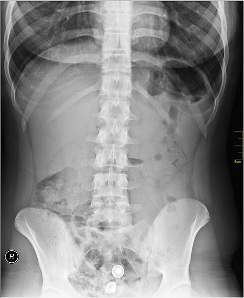 File:Medical X-Ray imaging PFL06 nevit.jpg