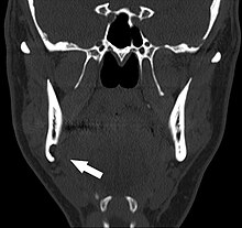 Coronal computed tomograph of the same person (Stafne defect arrowed). Stafne defect CT coronal.jpg