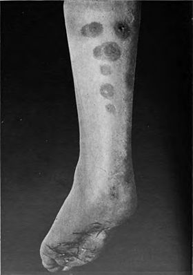 An introduction to dermatology (1905) erythema induratum 2.jpg