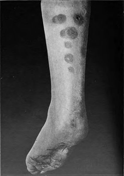 File:An introduction to dermatology (1905) erythema induratum 2.jpg