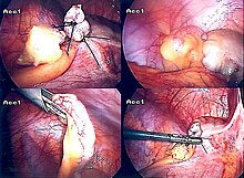Laparoscopic appendectomy. Appendix-Entfernung.jpg