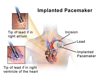 心臓ペースメーカー Wikiwand