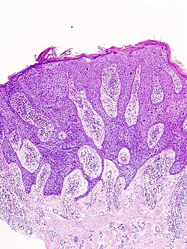 La enfermedad de Bowen bajo el microscopio