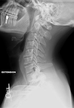 Neck Extension Xray