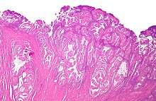 Adenocarcinoma endometrial endometrióide baixo mag.jpg