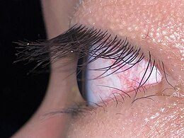 Eyelashes serve to protect the eye by catching dust and debris. Markedly prominent lashes can be seen here with some dust or debris caught on them Human eye, lateral view.jpg