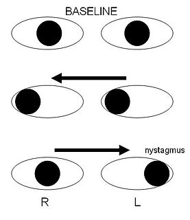 Internuclear ophthalmoplegia Human disease