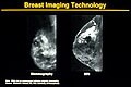Nádor prsu z pohledu dvou různých vyšetření. Zleva: a) Mamografie versus b) Magnetická resonance (MRI)