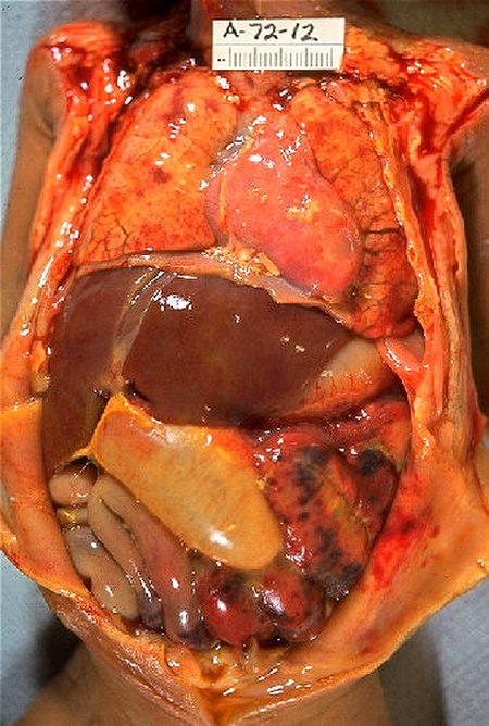 ไฟล์:Neonatal necrotizing enterocolitis, gross pathology 20G0021 lores.jpg