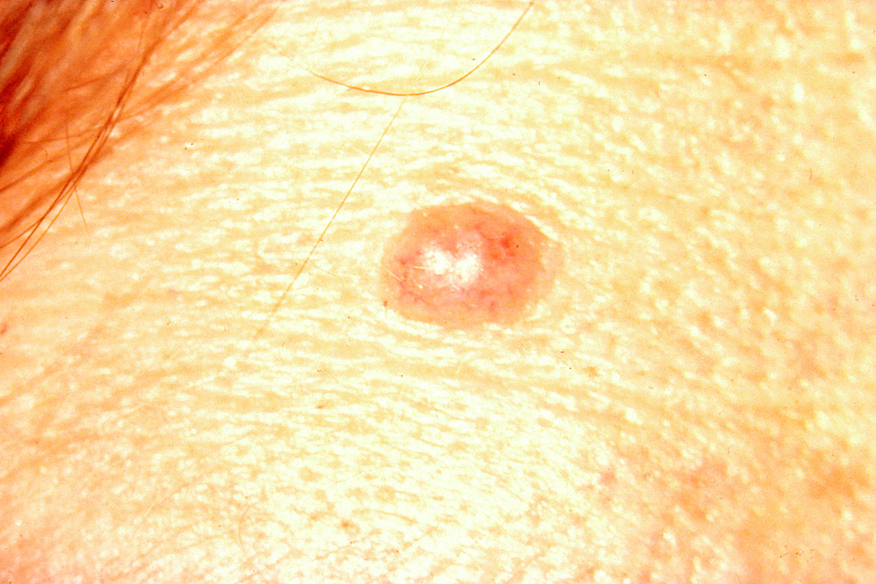 Melanoma - SkinCancer.org - Skin Cancer Foundation