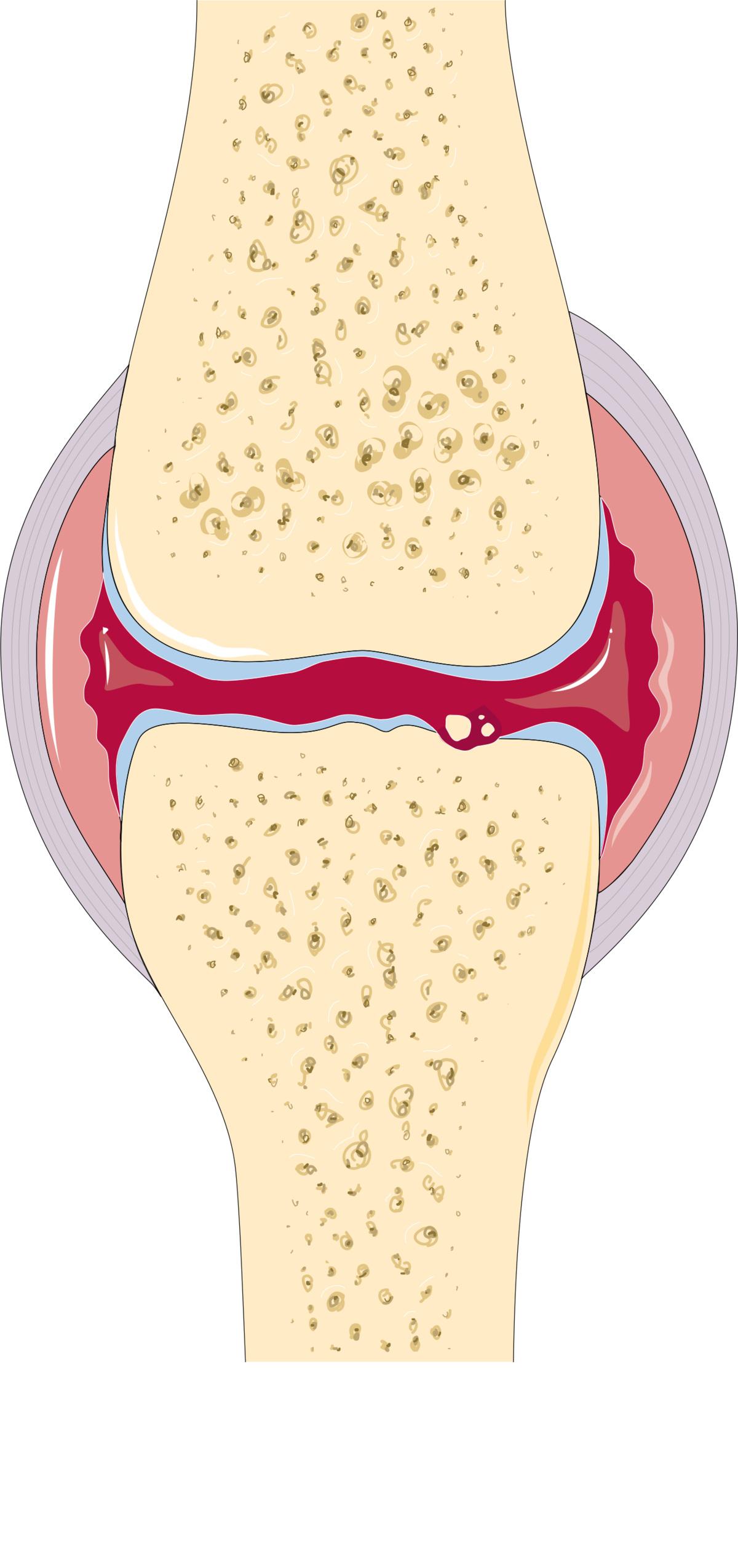 Arthrose — Wikipédia