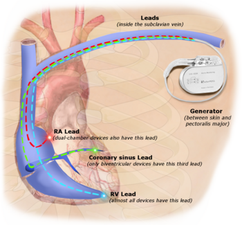 Illustration of implanted cardiac pacemaker showing locations of cardiac pacemaker leads PPM.png