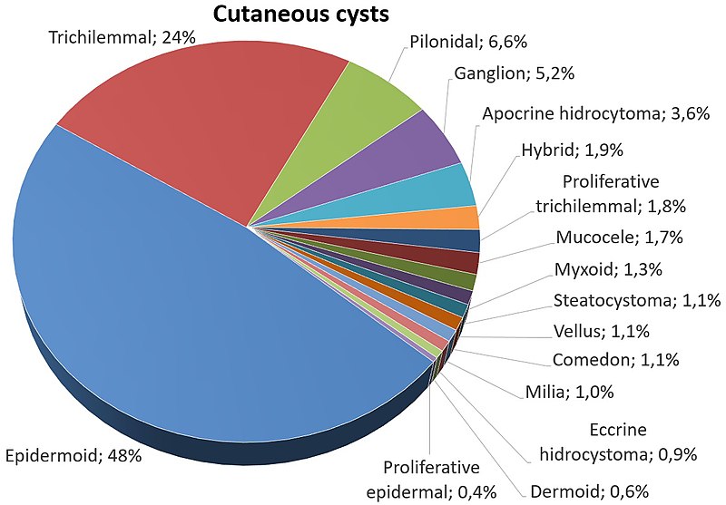 File:Relative incidence of cutaneous cysts.jpg