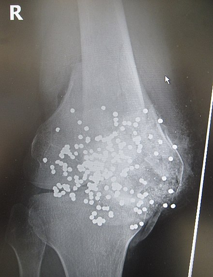 Radiograph of a close-range shotgun blast injury to the knee. Birdshot pellets are visible within and around the shattered patella, distal femur, and proximal tibia