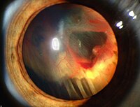 Slit lamp photograph showing retinal detachment in Von Hippel-Lindau disease EDA08.JPG