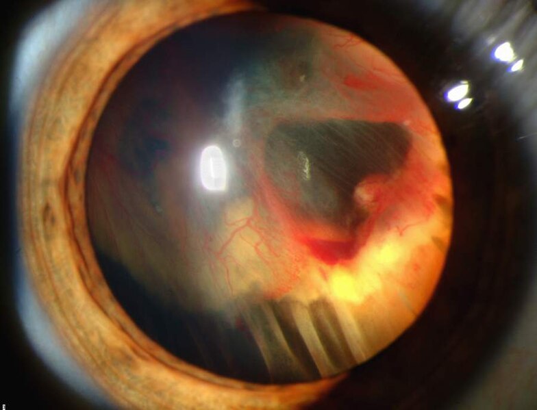 File:Slit lamp photograph showing retinal detachment in Von Hippel-Lindau disease EDA08.JPG