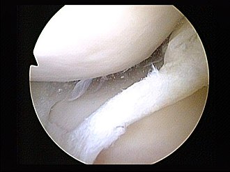 Tear of medial meniscus Tear of medial meniscus.jpg