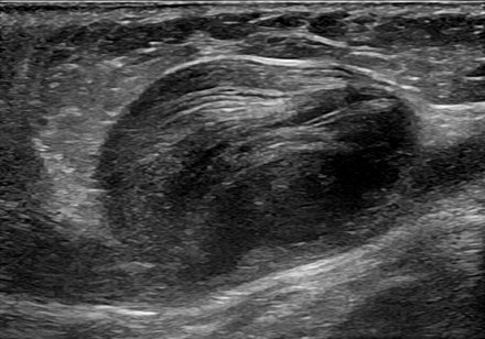Ultrasonography of an aneurysm of the great saphenous vein due to venous valve insufficiency.