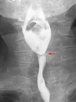 esophageal web barium swallow