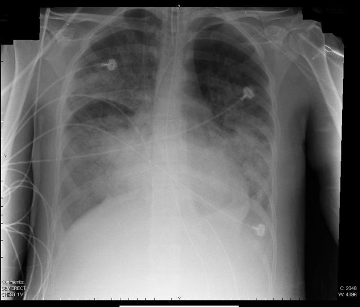 File:ARDS X-Ray.jpg