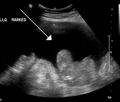 Ascites in a person with abdominal cancer as seen on ultrasound