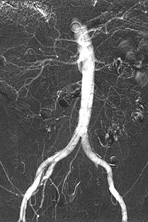 Carbon dioxide angiography Diagnostic radiographic technique