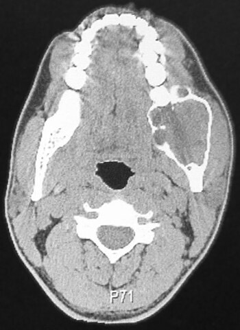 Ameloblastooman CT -skannaus.jpg