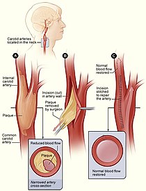 Steps of performing an endarterectomy on the carotid artery, in which the accumulated atheroma is removed via surgery. Cad endarterectomy.jpg