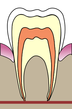 Cavities evolution 1.svg