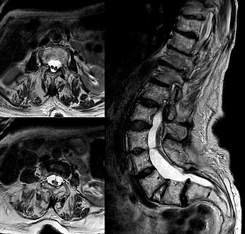 Diastematomelia in MRI of lumbar spine.